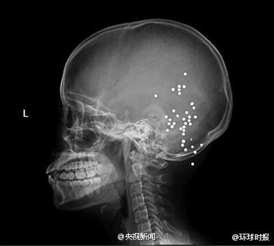 Woman with 36 Bullets inside Head Survives in Sichuan