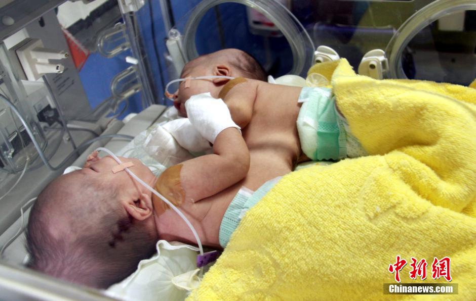 Conjoined twins successfully separated in Jiangxi