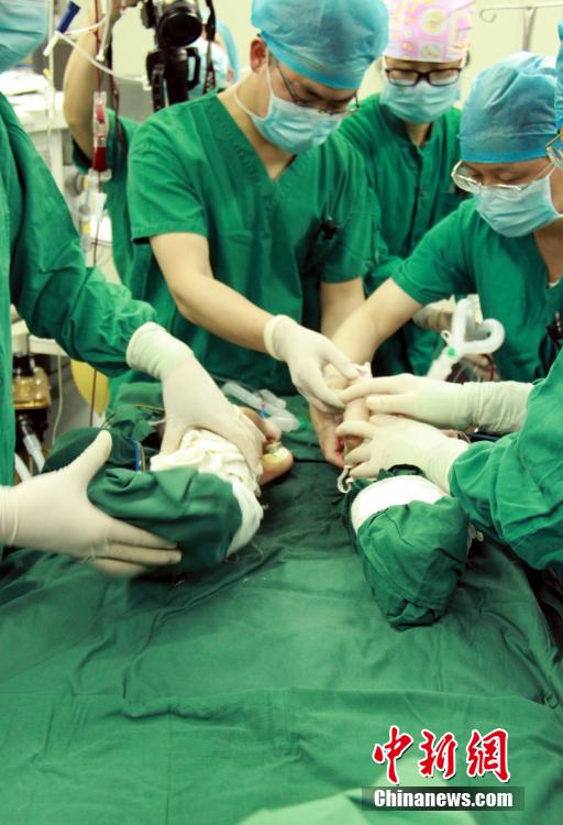 Conjoined twins successfully separated in Jiangxi