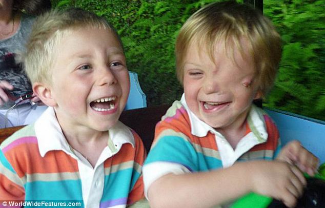 The 33-year-old British mother Charlene Machin had given birth to twin boys Oliver and Harry, but doctors discovered baby Harry had been born with a severe facial deformity, according to newspaper Daily Mail. Charlene and her two sons have overcome other people's prejudices and are a loving, close family. (Photo Source: huanqiu.com)