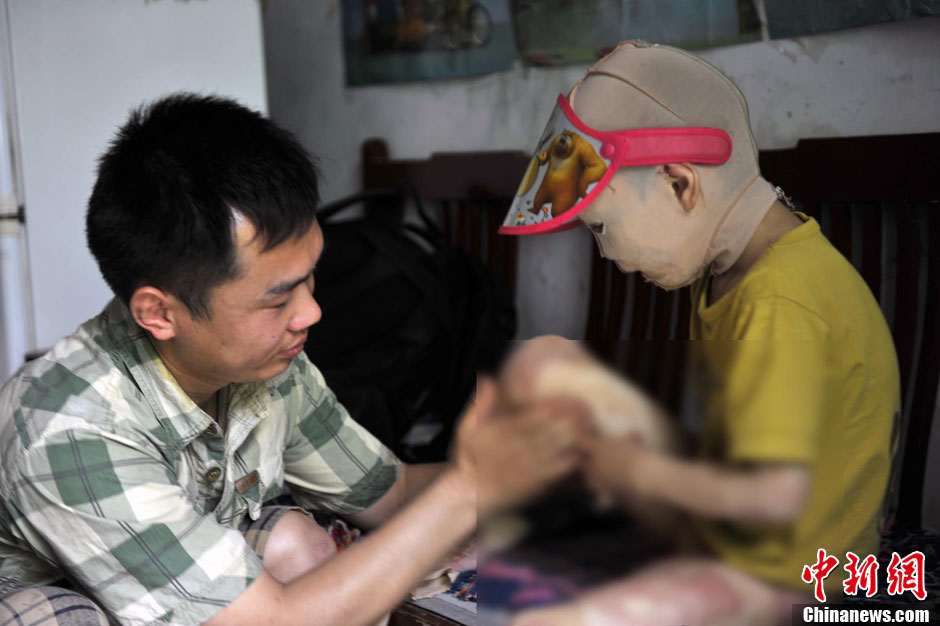 Cao suffers the itching caused by the sweat in summer. She can't scratch herself. Her parents have to pat her to relieve her pain. Her skin was seriously damaged in the accident. She couldn't perspire like a normal person. (Photo/Chinanews)